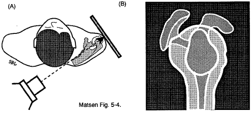 Figure 7 - Lateral view in the plane of the scapula