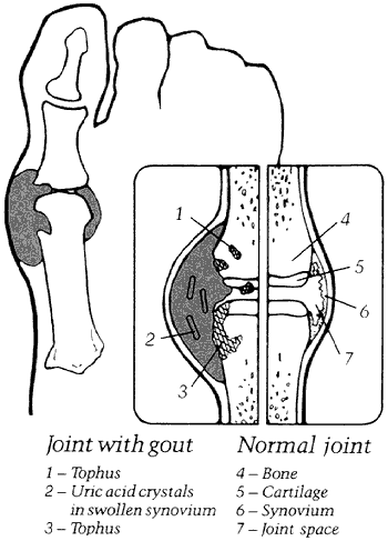 Figure 1 - Joint with gout versus a normal joint