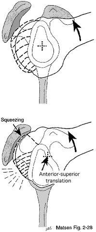 Figure 2 - Tightness of the posterior capsule