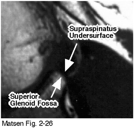 Figure 6 - Humeral head and glenoid in contact