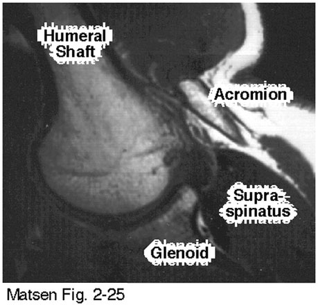 Figure 7 - Proximal humeral shaft contacting the acromion