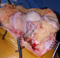 Figure 1 - Arthritic Knee