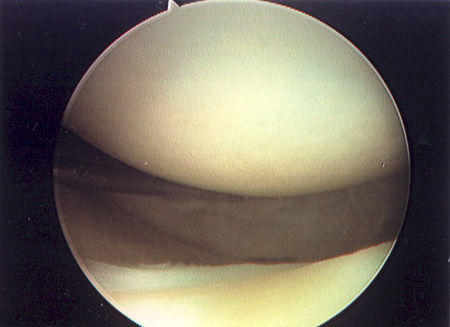 Figure 2 - Normal Cartilage
