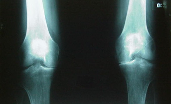 Figure 4 - X-ray showing arthritis of the knee