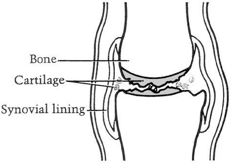 Figure 2 - Joint with severe osteoarthritis