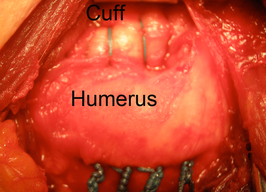 Repaired Rotator Cuff in surgical image
