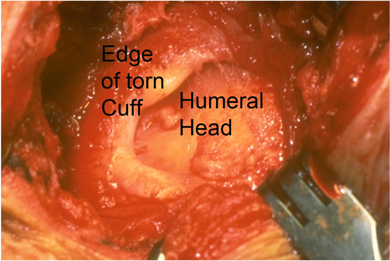 A Rotator Cuff Tear