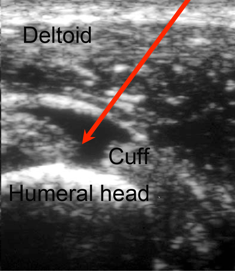 A Rotator Cuff Tear - Ultrasound Image