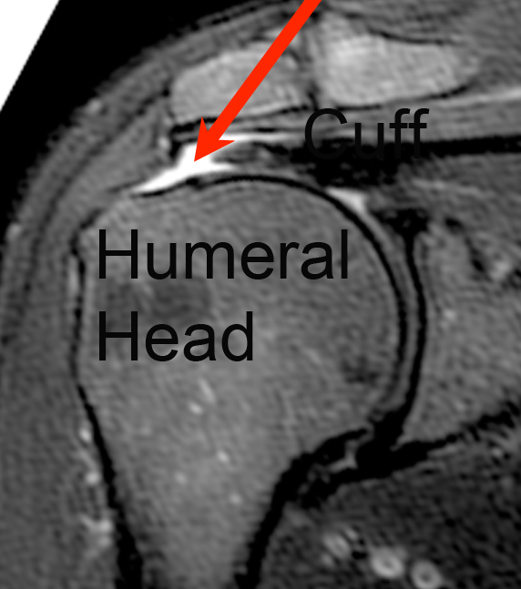 A Rotator Cuff Tear - MRI Image