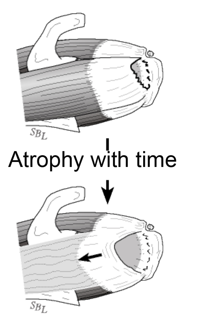 A Rotator Cuff Tear Atrophy With Time