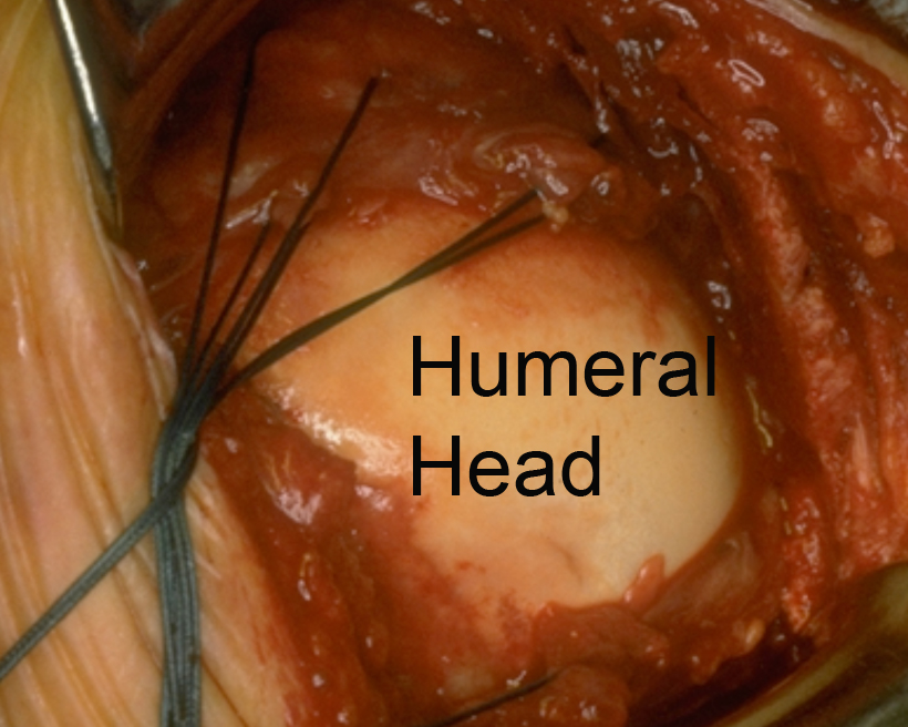 An Irreparable Rotator Cuff Tear
