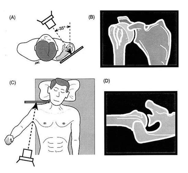 Shoulder arthritis X ray evaluation of the joint
