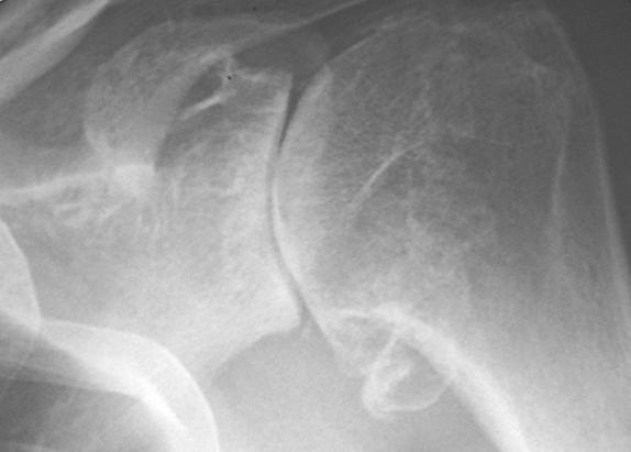 Shoulder arthritis X ray evaluation of the joint