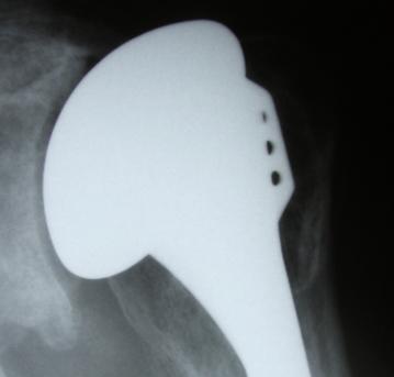 Shoulder arthritis ream and run