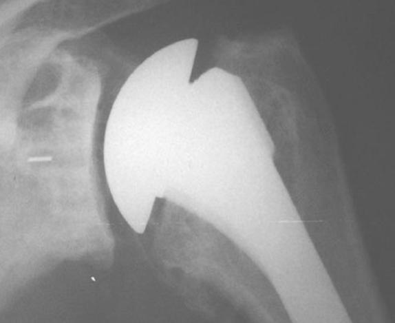 Shoulder arthritis total shoulder arthroplasty