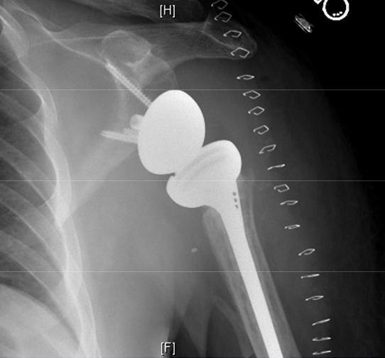 Shoulder arthritis reverse total shoulder