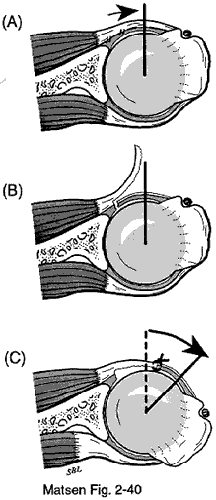 Figure 2 - Subscapularis lengthening