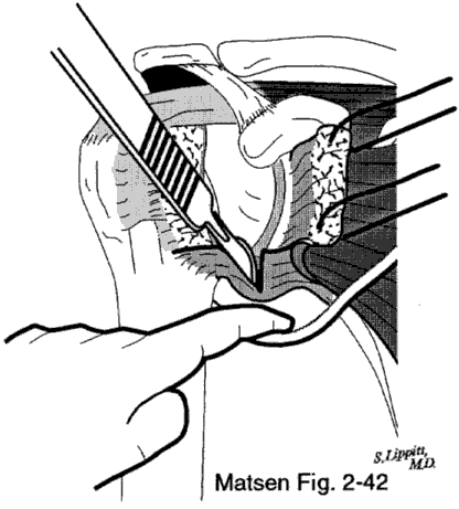Figure 4 - Releasing the inferior capsule sharply while a finger protects the axillary nerve