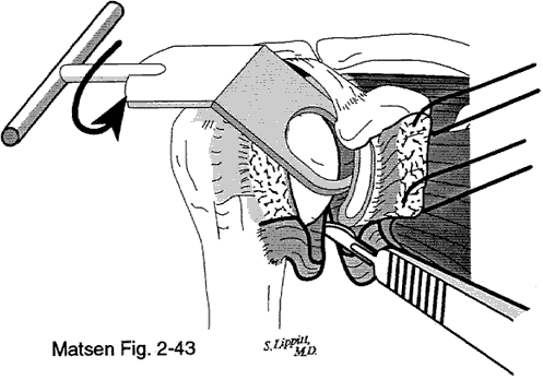 Figure 5 - Releasing the posterior capsule up to the origin of biceps tendon at the supraglenoid tubercle