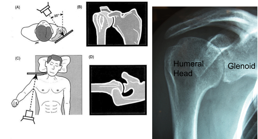 Diagnose Shoulder Arthritis
