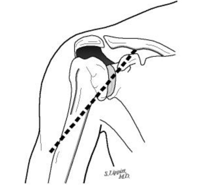 An incision between the deltoid and the pectoralis major muscles on the front of the shoulder