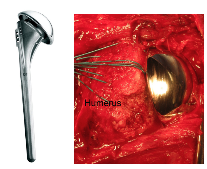 The arthritic surface of the ball is replaced with a metal ball