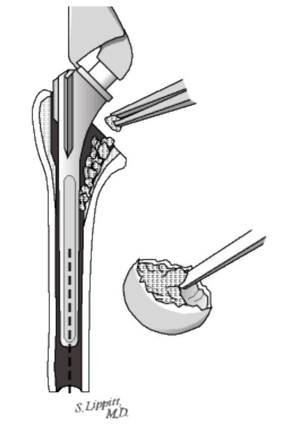 The Humeral Component fixed in the Humerus
