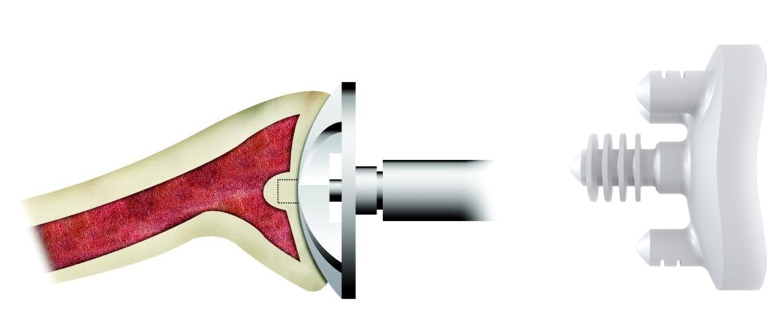 The Glenoid Component Fixed To The Glenoid Bone