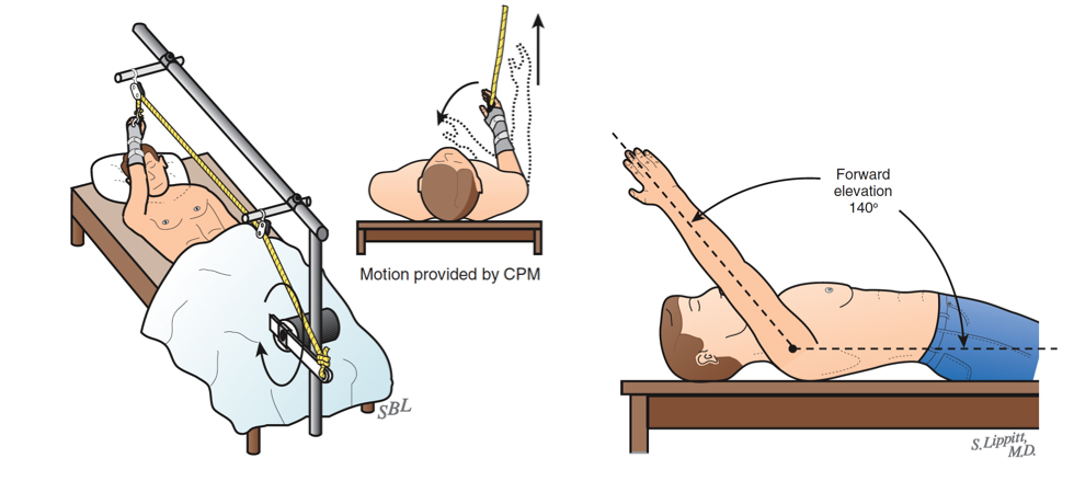 Rehabilitative exercises are started immediately after surgery