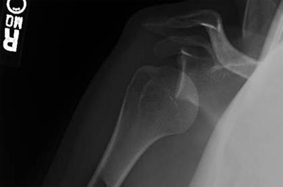 Figure 1 - Dislocated shoulder