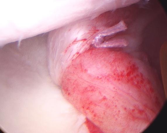 Figure 10 - Bankart (labral repair) seen from the front. Note the large restored bumper resisting excessive motion.