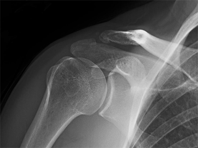 Figure 2 - Reduced shoulder