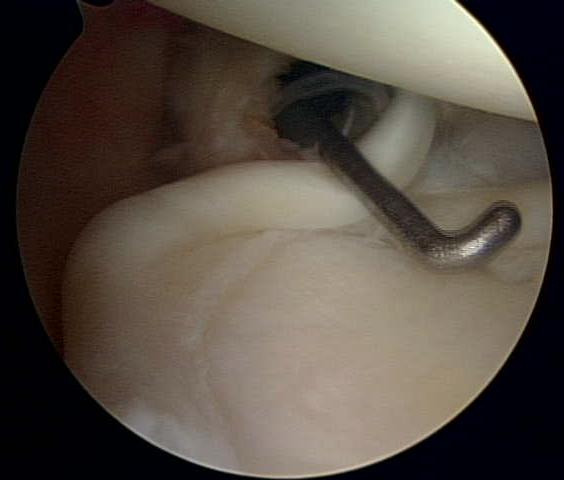 Figure 3 - Normal labrum and biceps tendon (under probe)