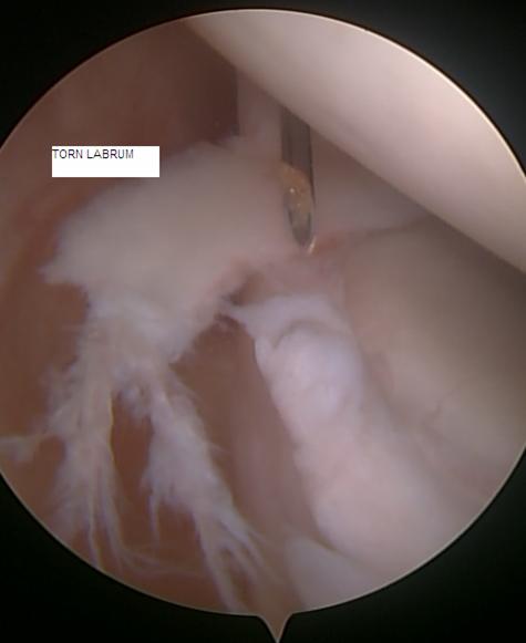 Figure 4 - Damaged cartilage (SLAP tear) at the top of the shoulder joint.