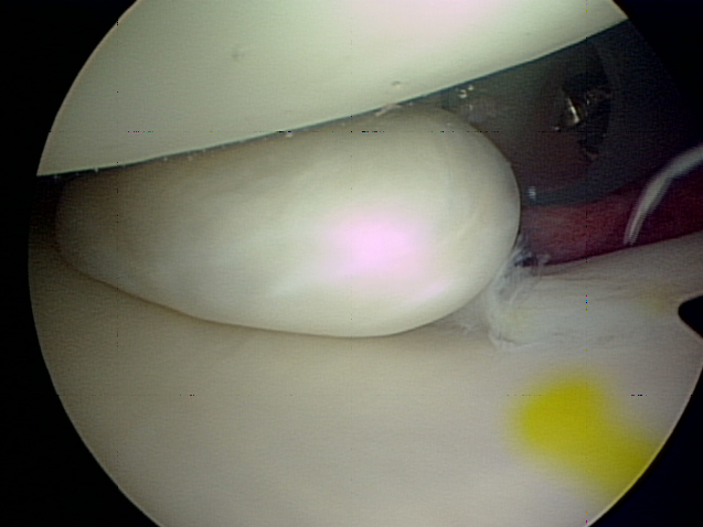 Figure 7 - Loose body in front of shoulder joint