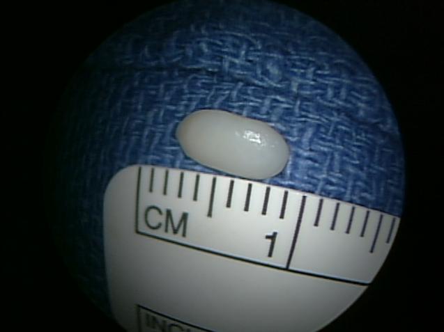Figure 8 - Loose body removed