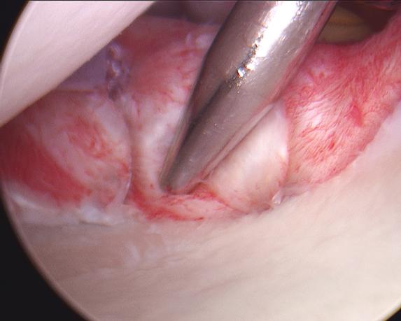 Figure 9 - Robust labral repair with sturdy bumper in the front