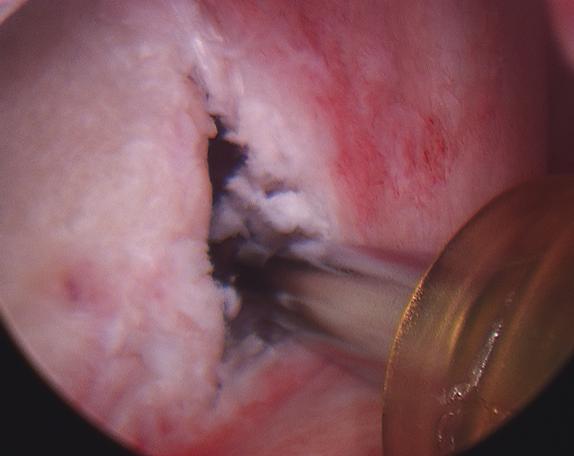 Figure 11 - Mobilized tissue with a shaving instrument seen through a yellow cannula