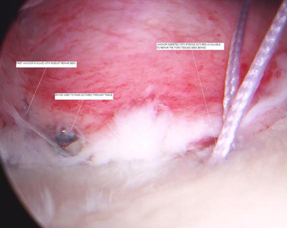 Figure 13 - Repairing ligaments to restore proper ligament tension in the front of the shoulder.