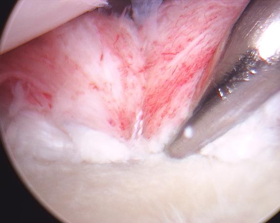 Figure 14 - Very sturdy repair with normalized ligament tension throughout the shoulder.