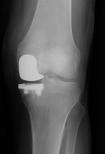 Figure 3 - X-ray of a partial or unicompartmental knee replacement. This operation is done for patients whose arthritis is limited to one side of the knee. It may be done through a very small incision and recovery from this procedure is usually much quicker than that seen with traditional total knee replacement.