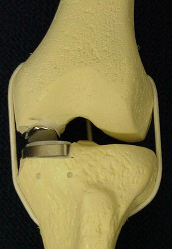 Figure 4 - Model of a partial knee replacement. This smaller implant leaves undamaged cartilage in other parts of the knee intact.
