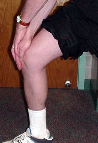 Figure 8 - Pain behind the kneecap from arthritis may occur along with arthritis elsewhere in the knee or in isolation. Isolated patellofemoral arthritis is the least common pattern of knee arthritis.