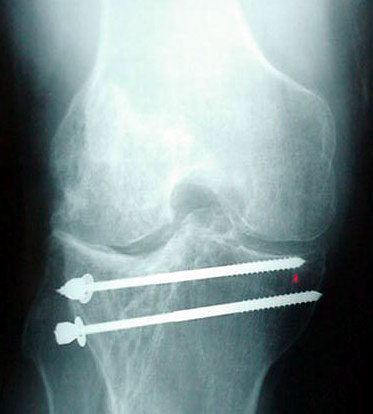 Figure 9 - This patient had diffuse arthritis throughout his knee from an old fracture of the tibia (shinbone) which at that time was treated with the two screws that are visible. This patient was later treated with a total knee replacement similar to the one shown in Figure 10.