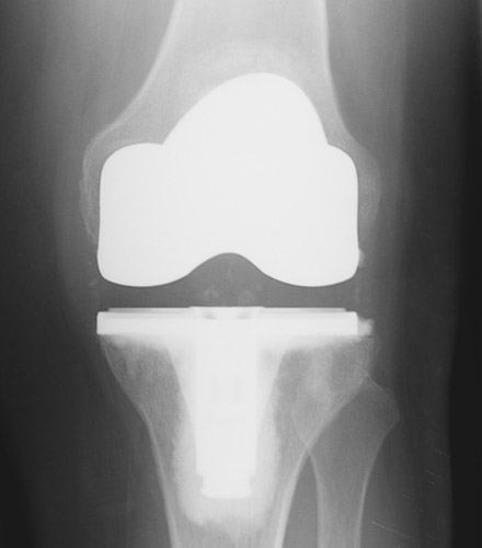 Figure 10 - This patient had rheumatoid arthritis and symptoms throughout her knee resulting in the traditional total knee replacement pictured here.