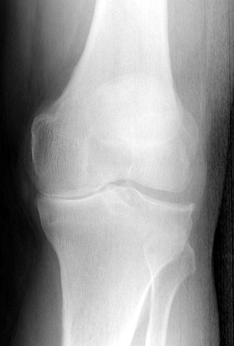 Figure 11 - This patient's arthritis was confined to the medial (inside) compartment of her knee on x-rays and her pain was localized to that part of the knee as well. She was a good candidate for minimally-invasive partial knee replacement.