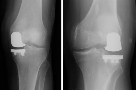 Figure 18 - Minimally-invasive partial knee replacements may be performed for either medial (inside of the knee) or lateral (outside of the knee) arthritis patterns provided the symptoms are limited to that one part of the knee. X-rays of two knee replacements are shown here. On the left is a lateral replacement and on the right is a medial replacement.