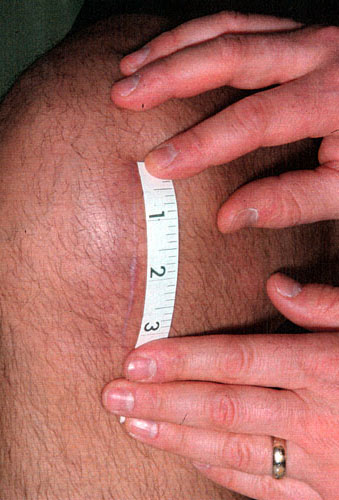 Figure 20 - This clinical photograph shows a typical incision used to insert the minimally-invasive partial knee replacement.