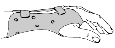 Figure 2 - Wrist splint