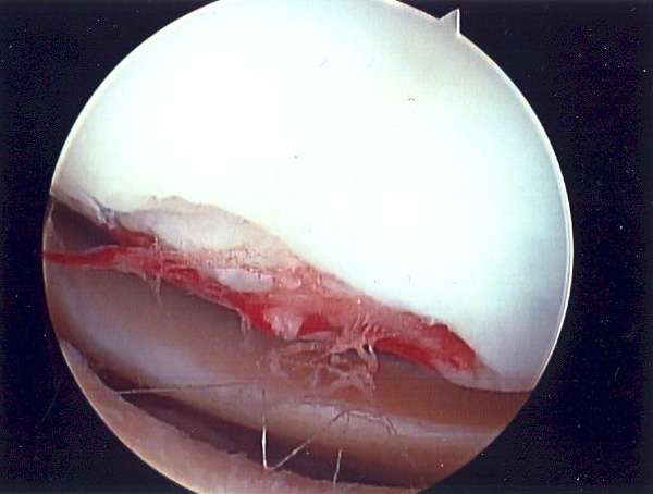 Figure 3 - Defect in joint surface cartilage